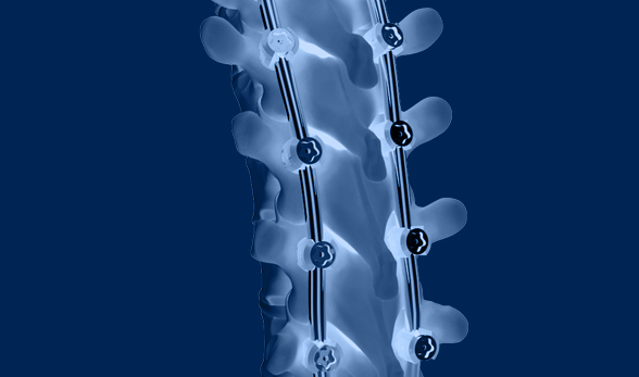 Complex Spine Surgery