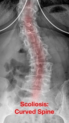 Scoliosis