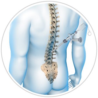 Endoscopic Spine Surgery